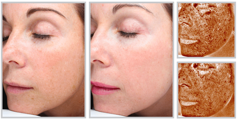 Advantages of Laser Skin Resurfacing With the Sciton® Halo™