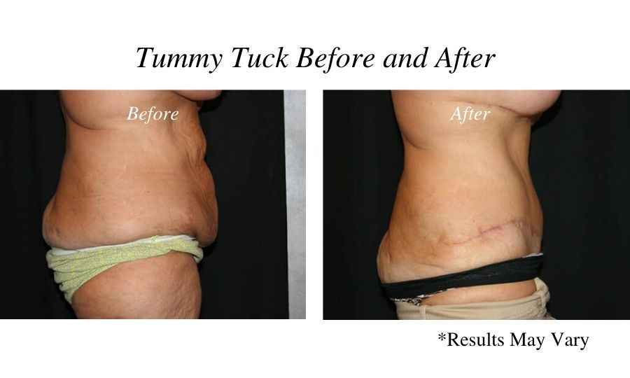 Before and after image showing the results of a tummy tuck performed by Dr. Bonaldi in Reno, Nevada.