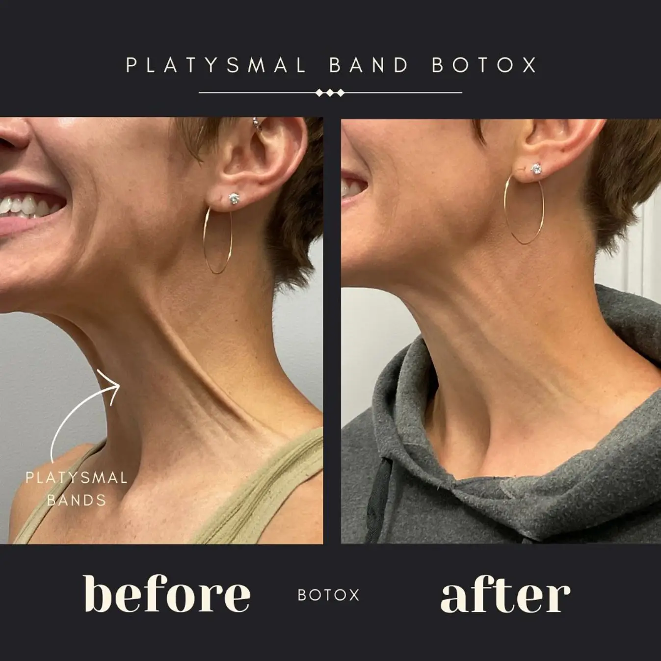 Before and after botox platysmal band