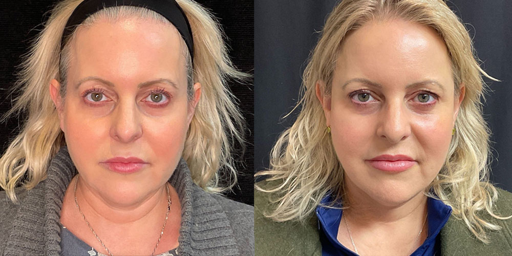 Facelift before and after photos of a younger female patient by Dr. Bonaldi